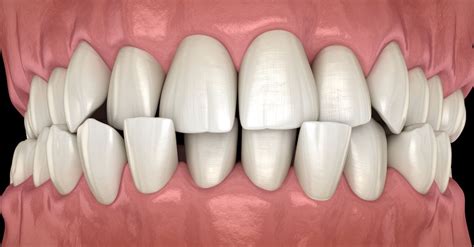 What is crossbite? Types, causes and treatments 🦷