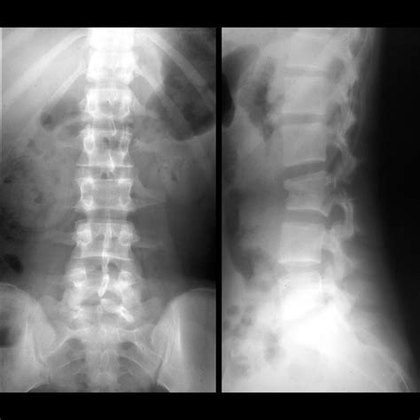 Pediatric Colonic Perforation | Pediatric Radiology Reference Article ...