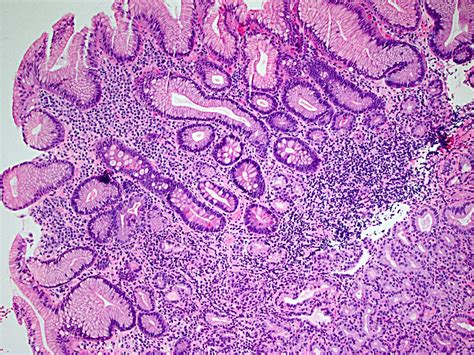 Gastric neuroendocrine tumors pathology - Carcinoid Cancer Foundation