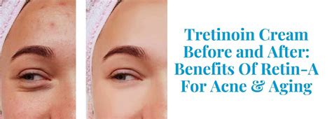 Tretinoin Cream Before And After Acne