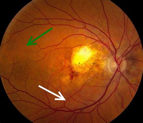 The images shows central atrophy with choroidal neovascularization in a ...