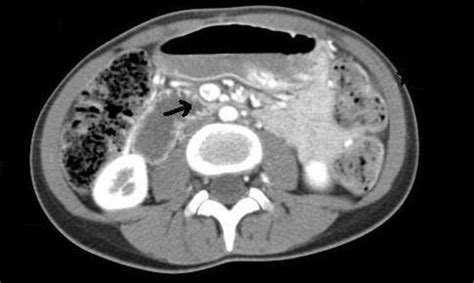 CT Scan of the Abdomen and Pelvis: With and Without Contrast ...