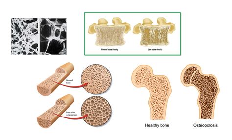 Understanding bone density tests can help prevent further problems.