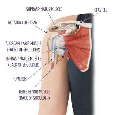 Rotator Cuff Injuries | Summit Orthopedics