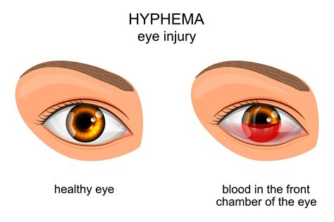 Understanding Hyphema: Symptoms, Treatment & More | NVISION Eye Centers