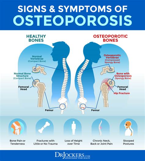 Osteoporosis Diagnosis