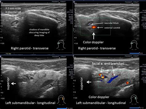 Salivary ultrasound standardized diagnostic approach and report | Iowa ...