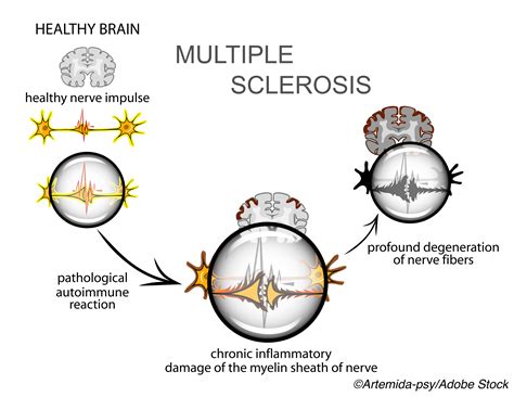 MS Disease-modifying Therapy Shows Reduced Disability Accrual Over 15 ...