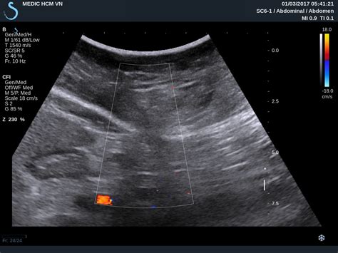 Lumbar Hernia Ultrasound