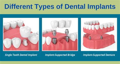 Different Types of Dental Implants - Dental Clinic