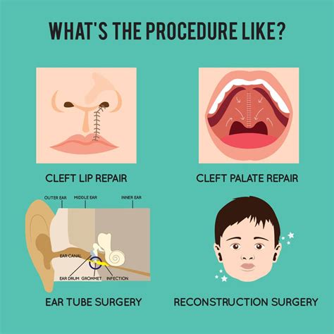 Cleft Lip and Palate Repair (Correct Baby's Facial Structures) | Trambellir