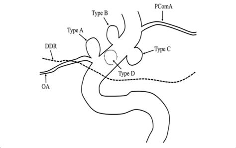 | Ophthalmic segment aneurysm classification. Aneurysms arising from ...