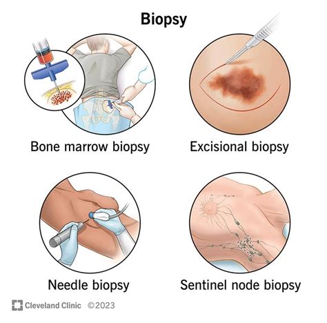 What Is a Biopsy? Purpose & Results