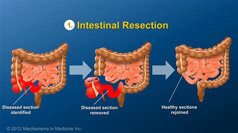 Slide Show - Small Bowel and Large Bowel Surgery for IBD