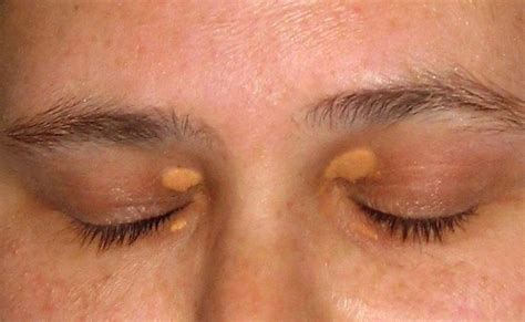 Xanthelasma: Causes, Symptoms and Treatment