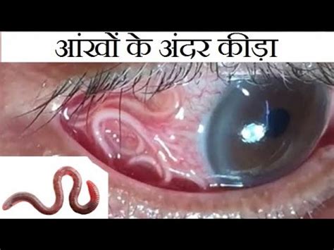 आंखों के अंदर कीड़ा (LOIASIS), Rarest eye disease. - YouTube