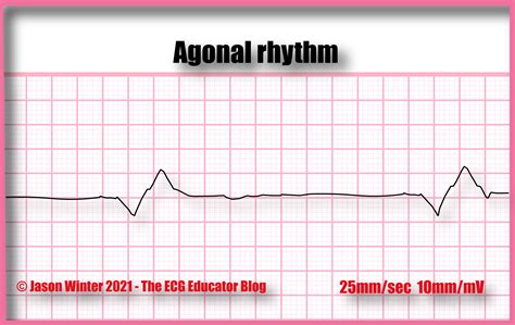 ECG Educator Blog : Agonal Rhythm