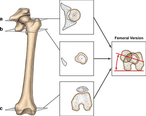 How frequent is absolute femoral retroversion in symptomatic patients ...