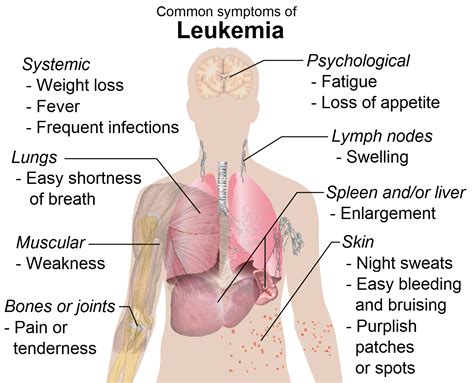 File:Symptoms of leukemia.png