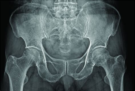 X-rays and scans can fail to differentiate hip pathology from lumbar ...