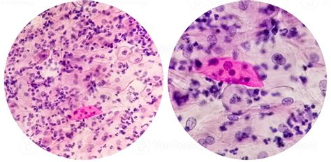 Paps smear. Microscopic examination of pap smear showing inflammatory ...