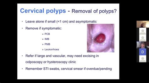 Cervical polyp training & HRT webinar discussion on Vimeo