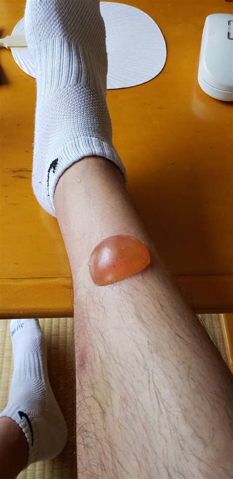 HUGE blister from mosquito(?) bite : r/AskDocs