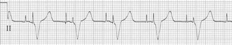 Ventricular Paced Rhythm