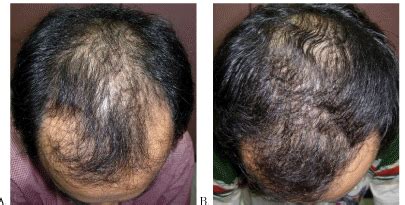 Finasteride Results: Timeline, Photos, Before & After