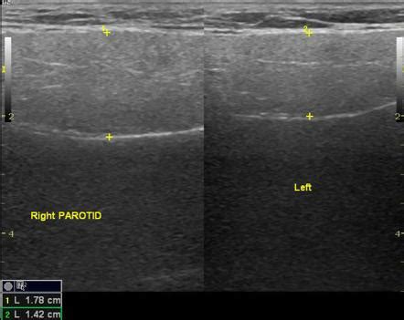 Parotid Gland Swelling Ultrasound