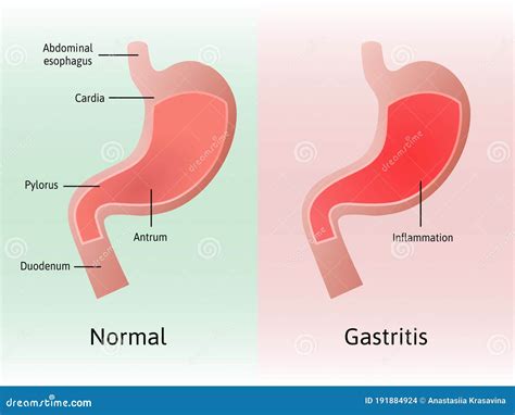 What Is Erythema In Stomach