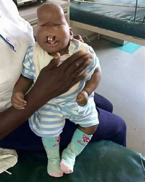 Breaking barriers: A special baby with a severe facial deformity ...