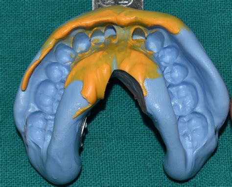 Final impression of the mandibular arch using single step putty wash ...