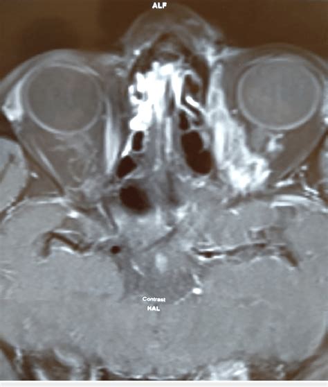 MRI of orbit revealed swollen left optic nerve and capillary hemangioma ...