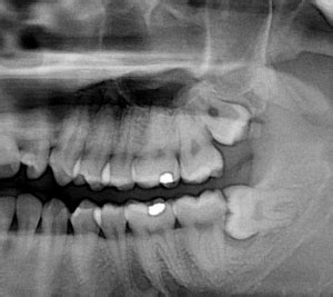 5 Serious Complications from Impacted Wisdom Teeth