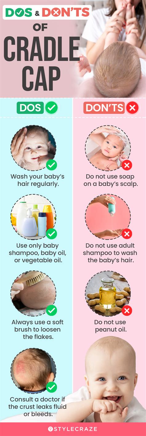 How To Get Rid Of Cradle Cap In Toddlers & Tips To Prevent It