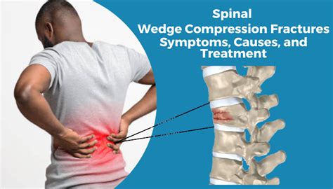 Compression Fracture Lumbar