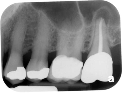 Maxillary Sinuses – Dr. G's Toothpix