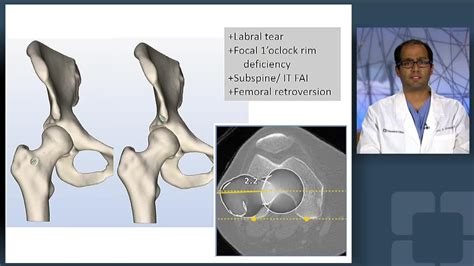 How Common Is Femoral Retroversion? The 8 Latest Answer ...