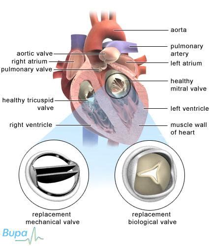 Heart valve surgery