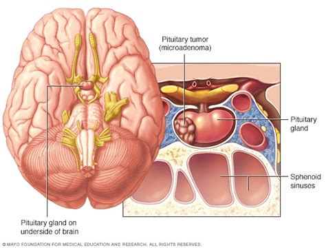 Pituitary tumors - Symptoms and causes - Mayo Clinic