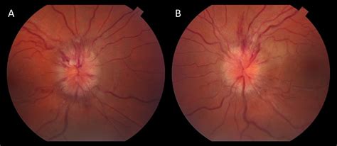 Moran CORE | Disc Edema