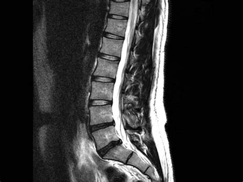 Back Pain and Normal MRI, is it possible?: Advanced Pain Management ...