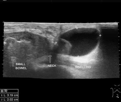 Private Hernia Ultrasound in Glasgow — Accurate Diagnosis and ...