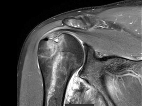 Bankart Lesion - Diagnosis - MRI Online