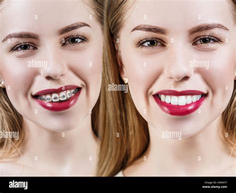 Perfect teeth before and after braces Stock Photo - Alamy