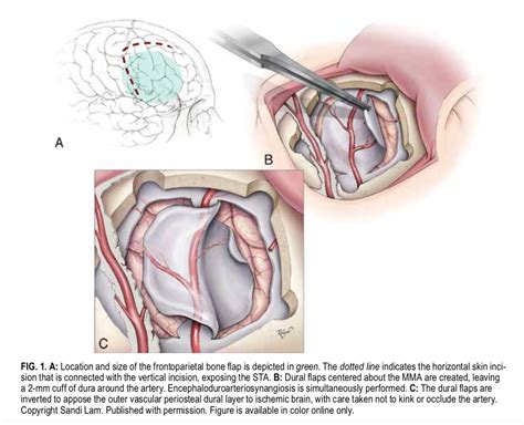 moyamoya - Pediatric Neurosurgery