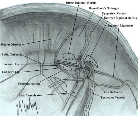 Laparoscopic Inguinal Hernia Surgery Anatomy