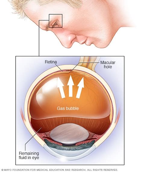 Retinal Detachment: Causes, Symptoms & Treatments | Global Treatment ...