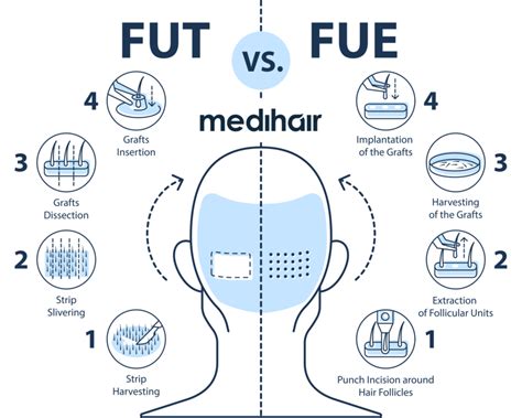 FUE Hair Transplant (Cost, Side Effects and Before and After)